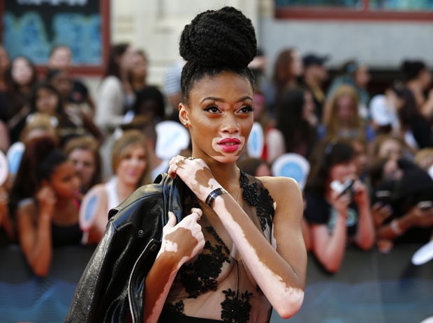 Tyra Banks phát hiện người mẫu bạch biến cho America’s Next Top Model